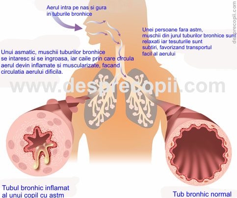 Infectiile cailor respiratorii inferioare - bronsiolita acuta